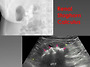 Renal Stagho..