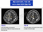 폐암 뇌전이 micro-RNA..