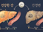 간암 환자 콜레스테롤 약 ..