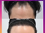[30대 남자 심한 C자탈모 ..