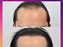 [20대 남자 심한 C자탈모 ..