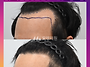 [30대 남자 깊은 M자탈모 ..
