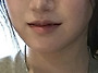 이중턱 지흡 + 턱끝 근육묶..