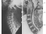 spine subluxation