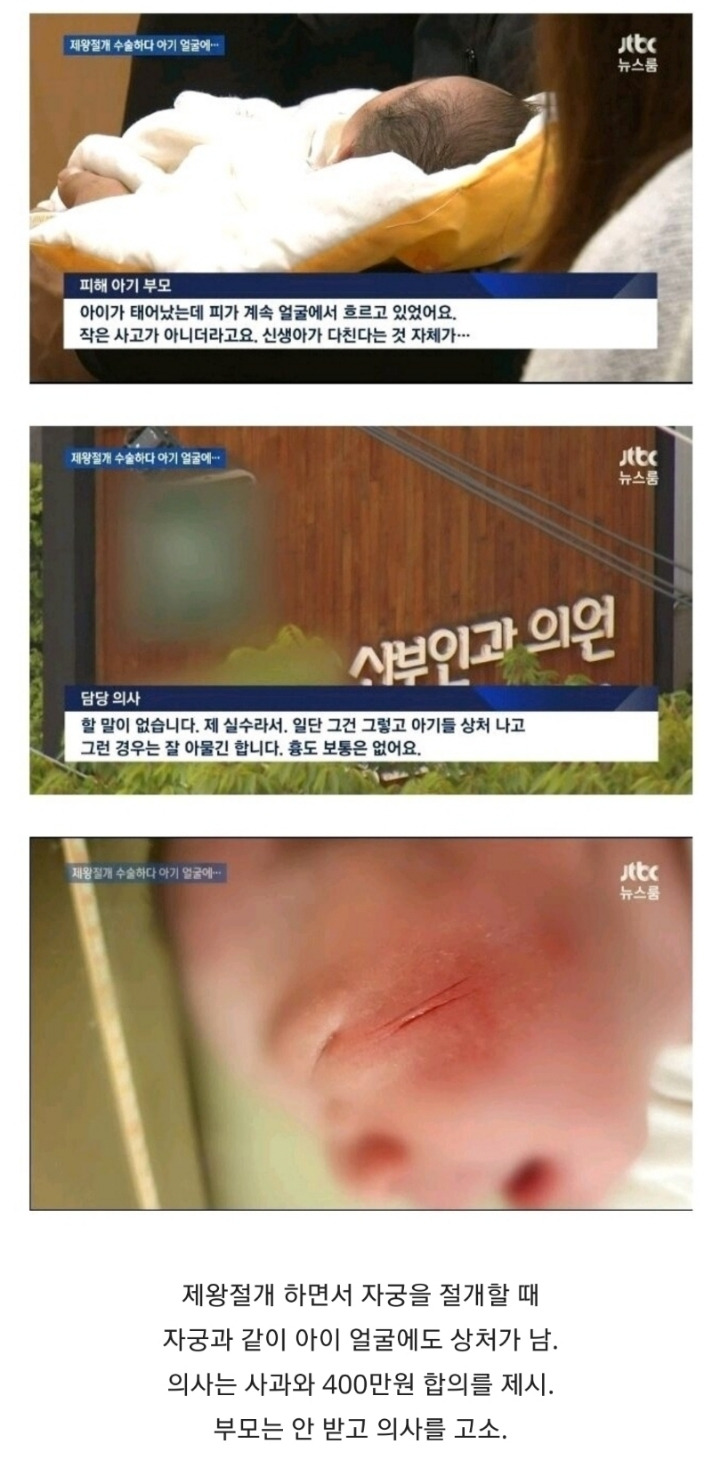 산부인과 제왕절개 사고