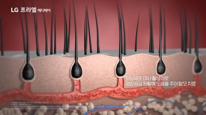 LG가 만든 FDA 승인 받은 탈모 치료기 - 꾸르