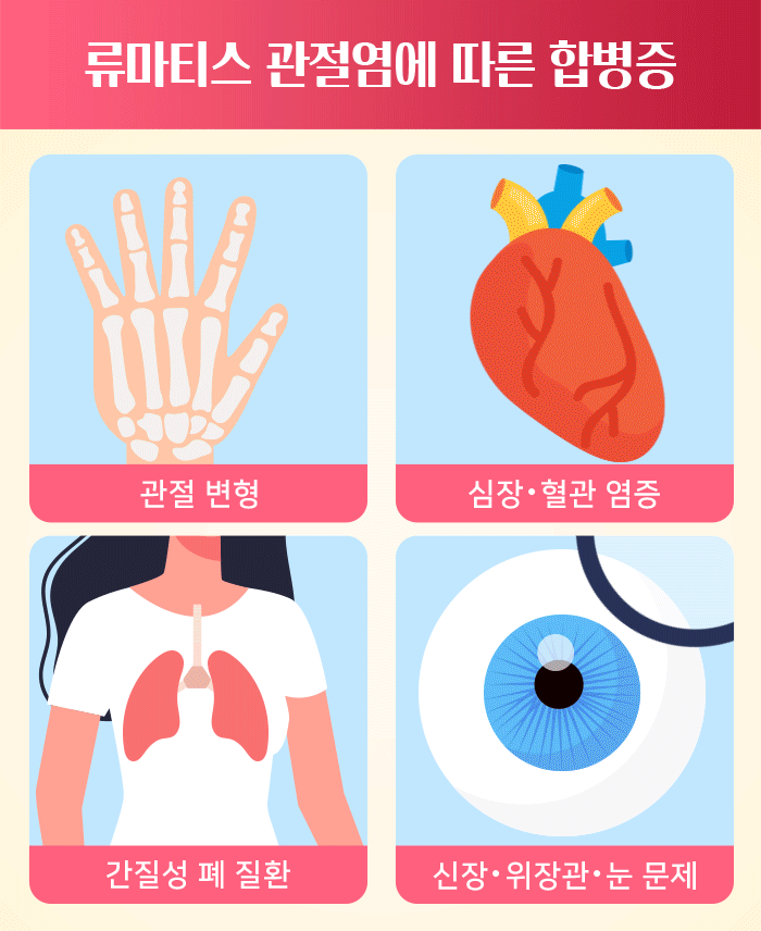 류마티스 관절염_06.gif