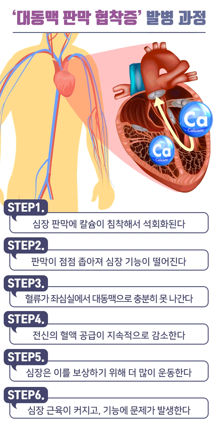 대동맥 판막 협착증_05.gif