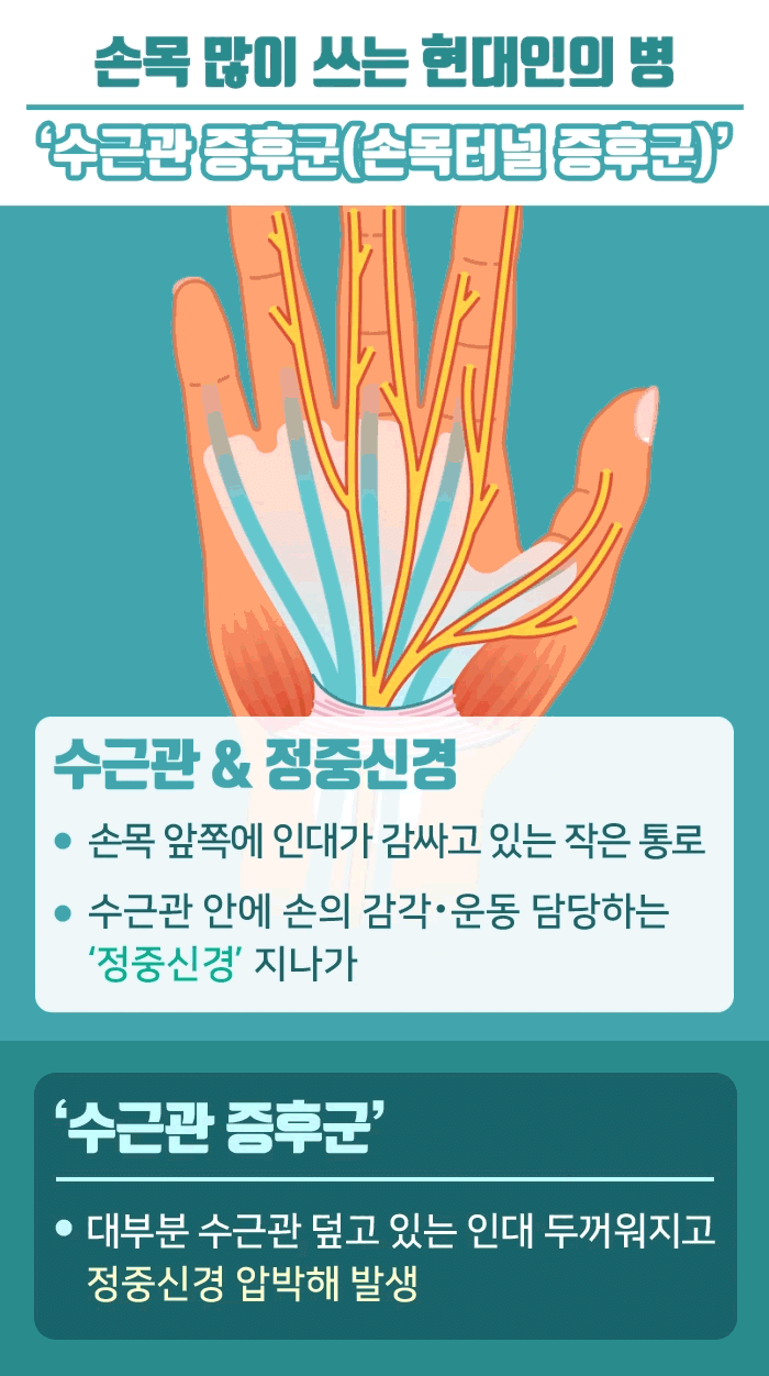 수근관-증후군_02.gif
