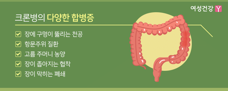6.※크론병의 다양한 합병증.gif