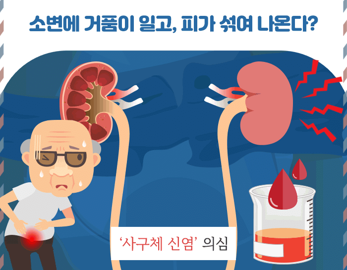 사구체 신염_2.gif