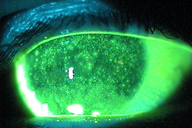 Punctate keratitis [Image credit Permission granted by 2022 American Academy of Ophthalmology.gif