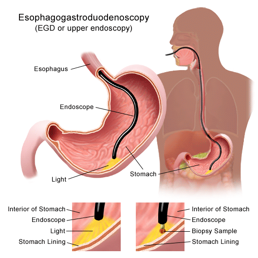 stomach-cancer-diagram-stomach.gif