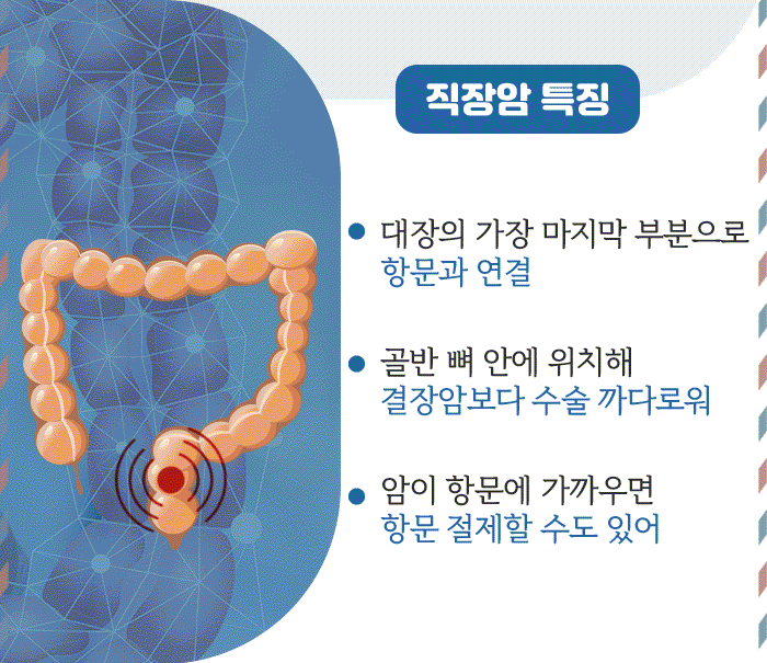 ‘직장암’ 환자 항문 살리는