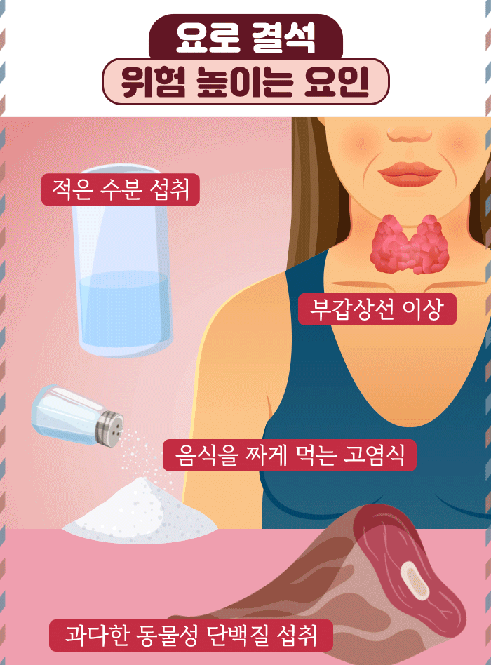 소변길 불청객 ‘요로 결석’