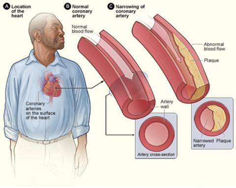 Coronary_heart_disease-atherosclerosis_coronary-artery-disease.jpg