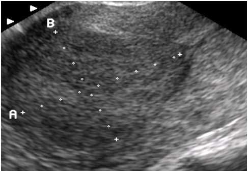 자궁근종 초음파.jpg