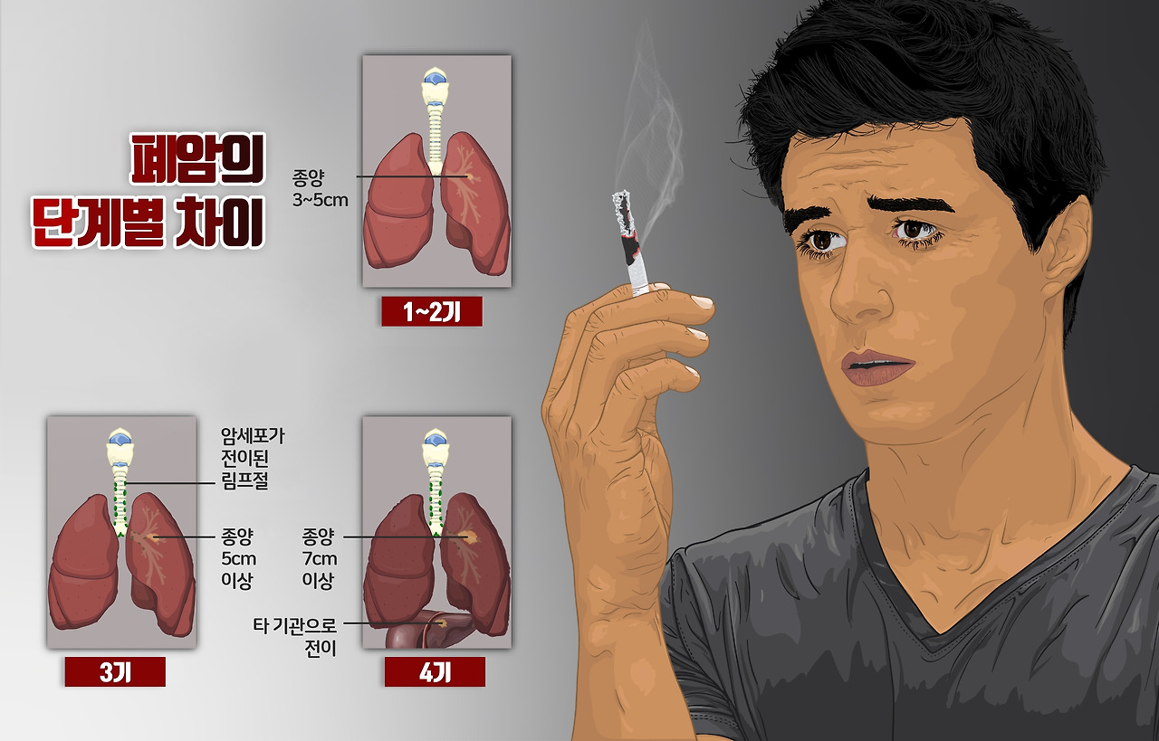 Depiction_of_a_person_smoking_and_stages_of_Lung_Cancer.jpg