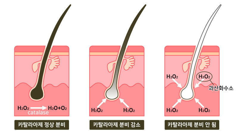 과산화수소 축적에 의해 백발이 되는 과정.jpg