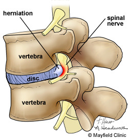 PE-HerniatedLumbar_Figure2b.jpg