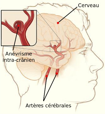 Cerebral_aneurysm-fr.svg.jpg