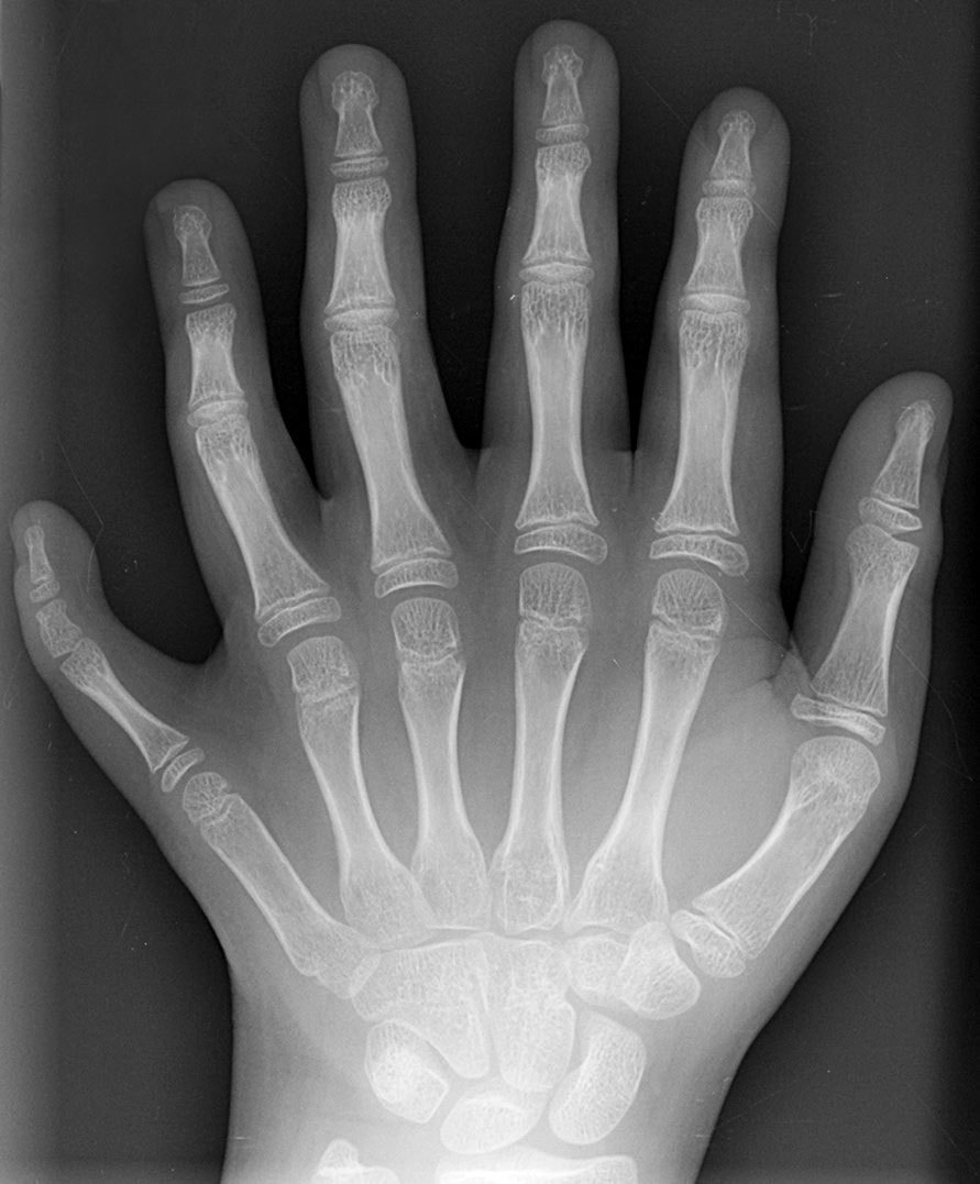 wiki-polydactyly.jpg