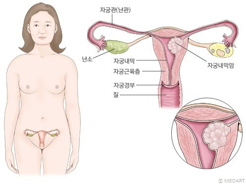 자궁내막암정의.jpg