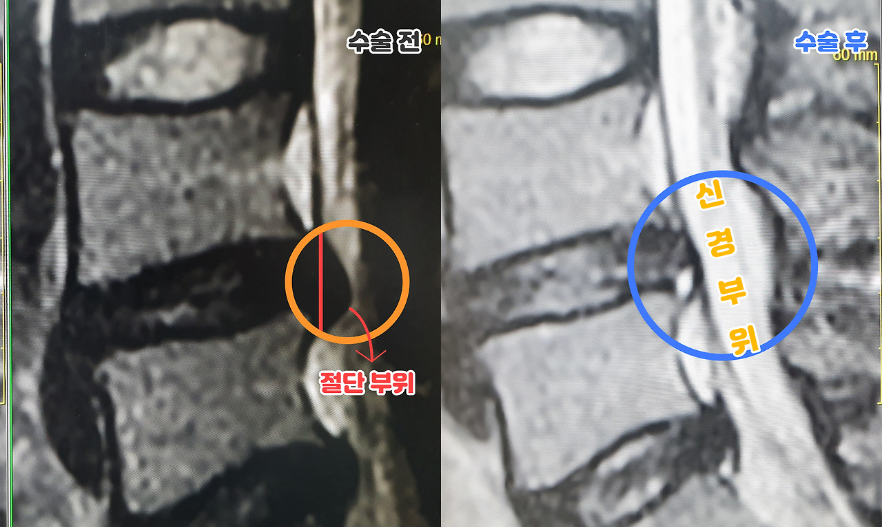 허리디스크-신경.jpg