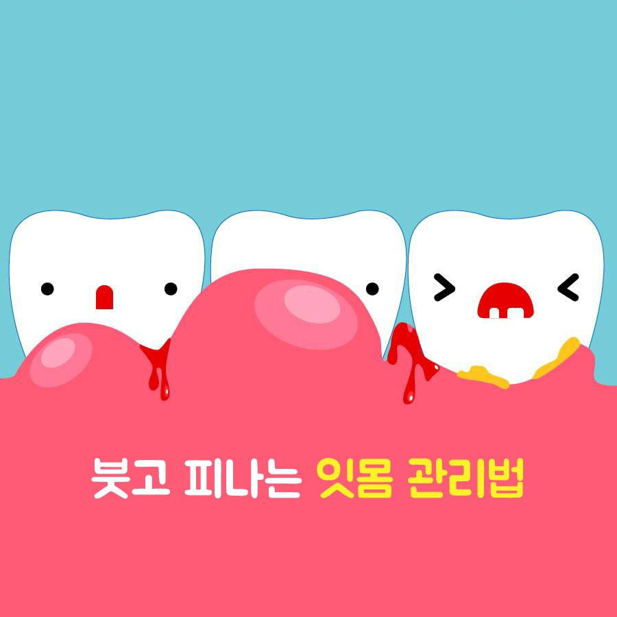 간질간질 붓고 피나는 잇몸, 관리법은 “먹고! 닦고! 씻고!”.jpg