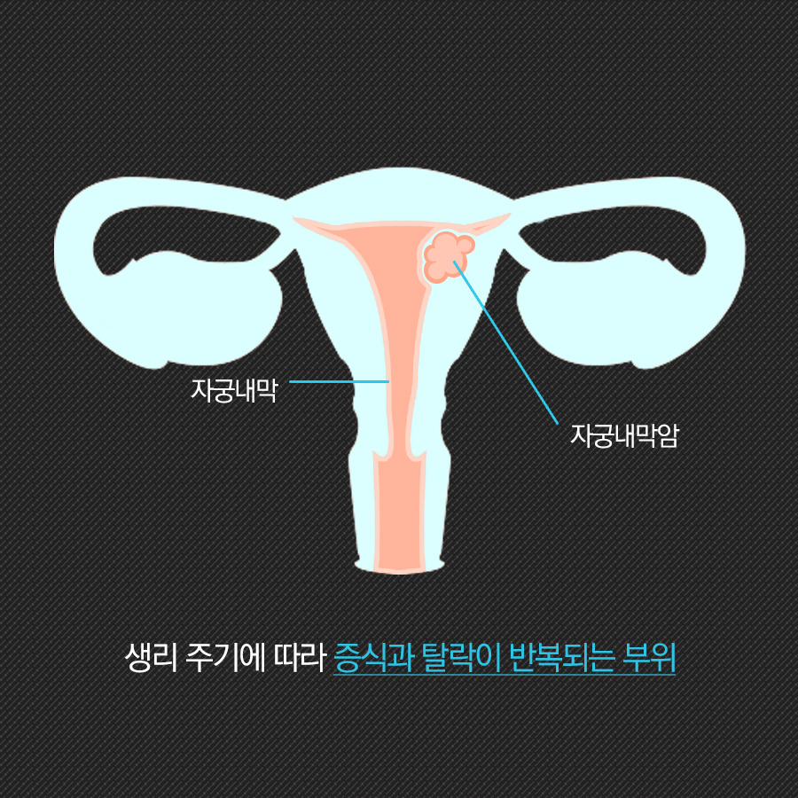 달달한 음료! 자궁암 원인이 될 수 있다!1.jpg