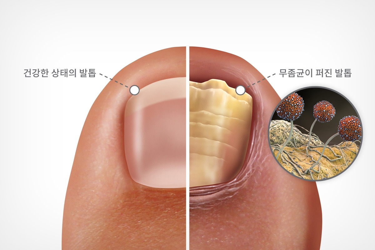 발톱무좀.jpg