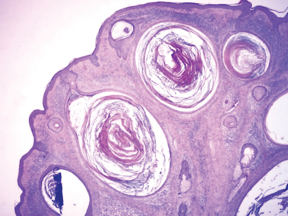 milium histology.jpg