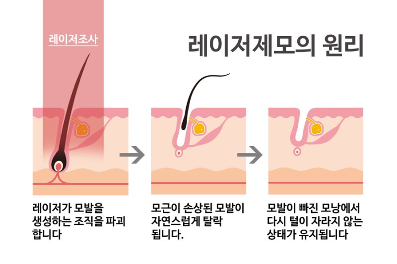레이저제모의_원리_copy.jpg
