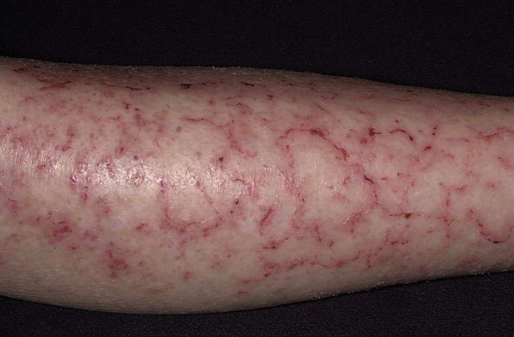 Asteatotic-Eczema-1.jpg