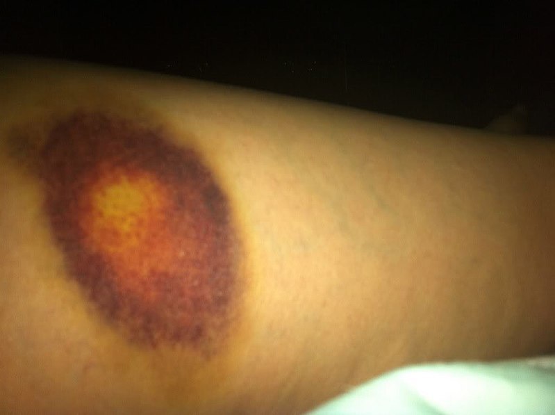800px-Bruise_Hematoma_from_abuse_of_spouse.jpg
