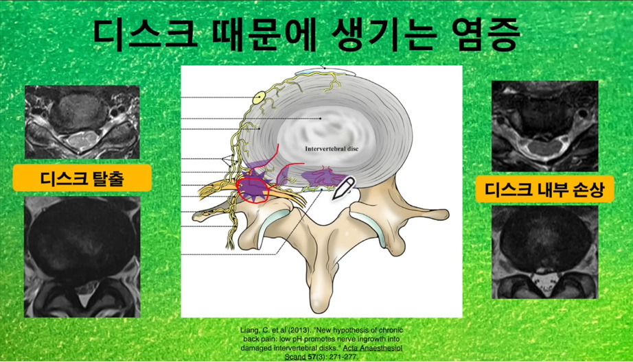 디스크_통증_1.jpg