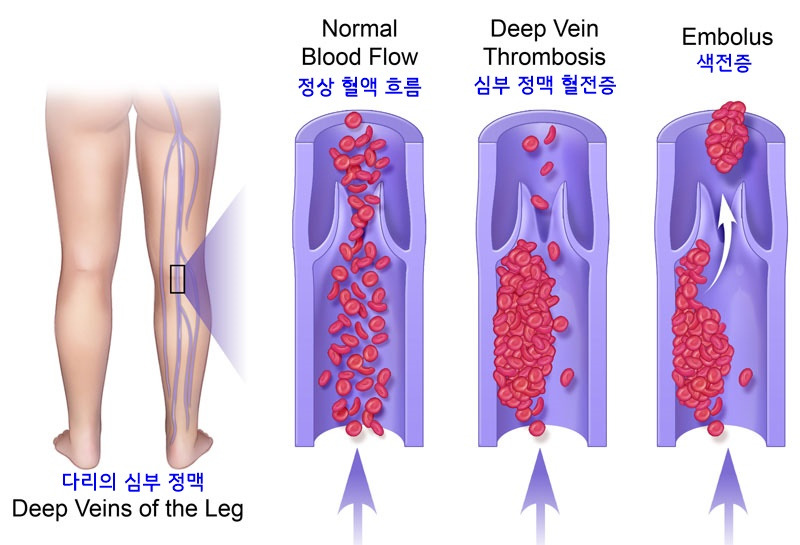 심부정맥 혈전증.jpg