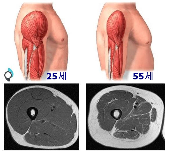 제2의 심장_종아리_근육_근육감소_근육감소증.jpg