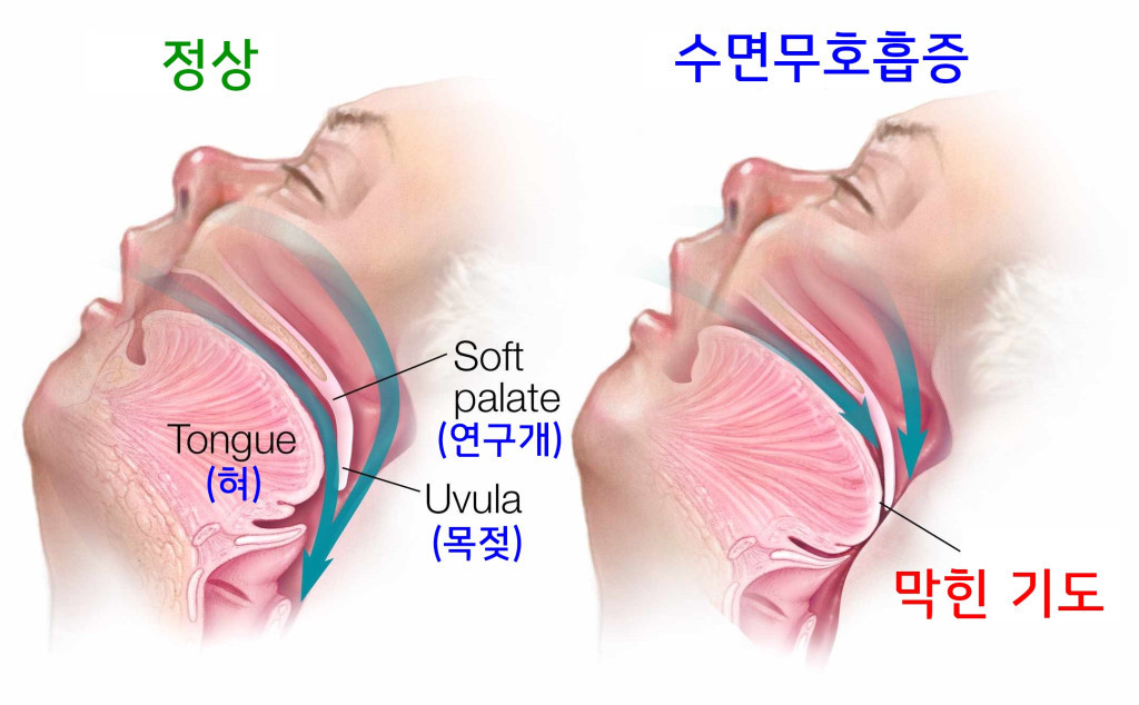 코골이_수면무호흡증_기도_푸샵_s_1.jpg