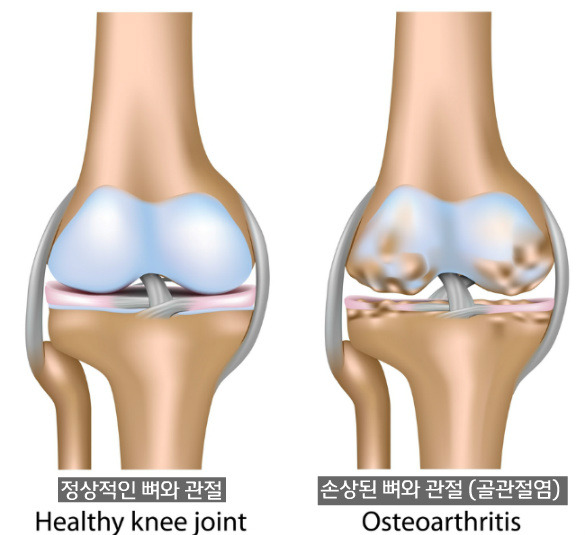 뼈와 관절_푸샵.jpg