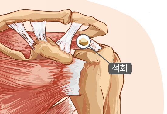 Shoulder-Pain-Vector_어깨,회전근개.jpg