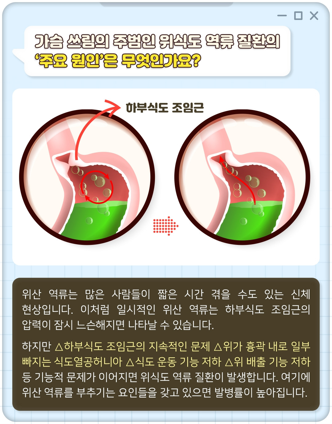 위식도역류_04.jpg