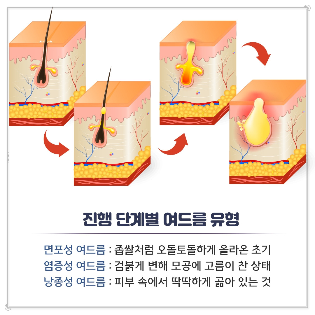 성인여드름_07.jpg
