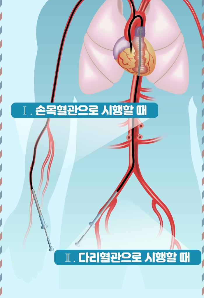심혈관조영술_05.jpg