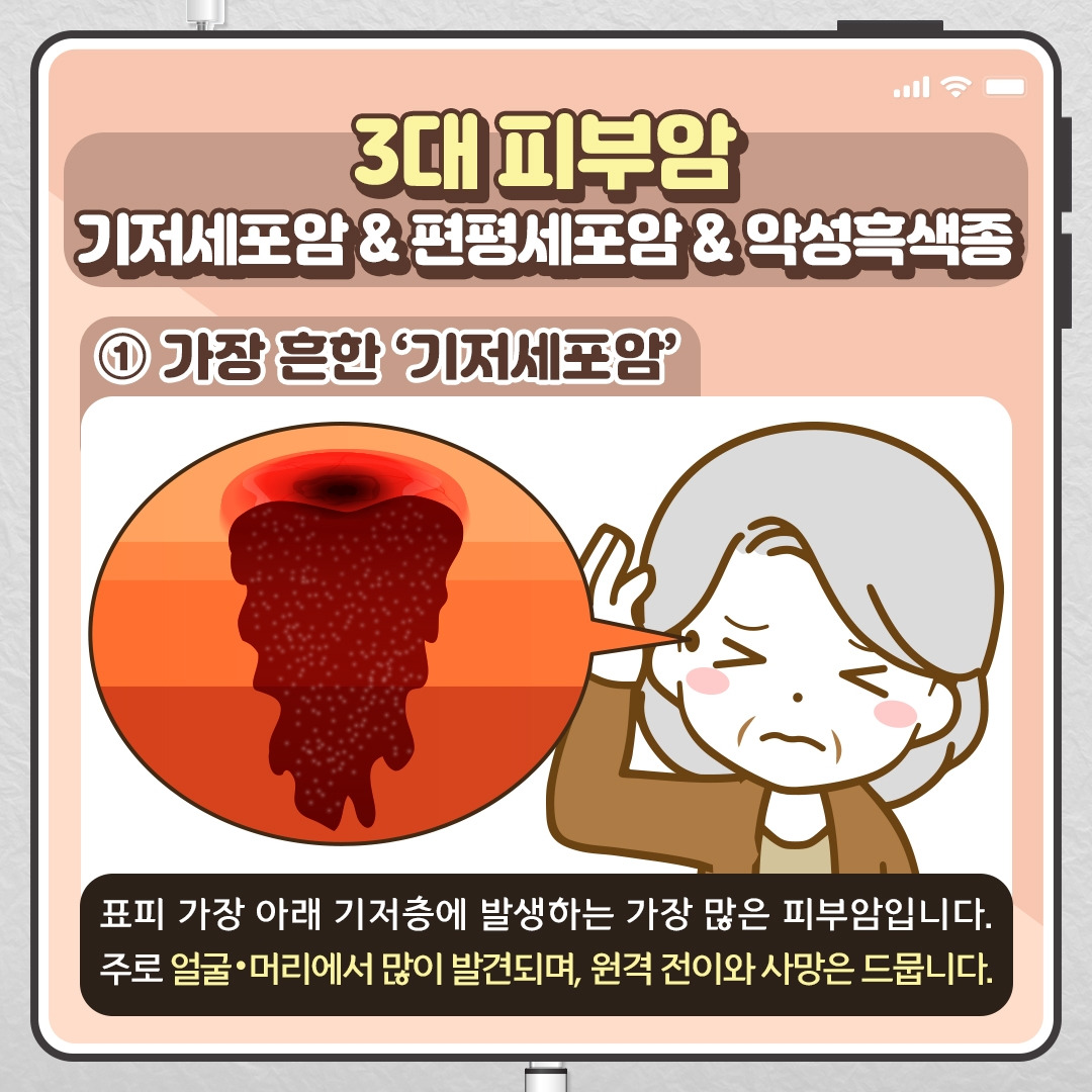 피부암_05 .jpg