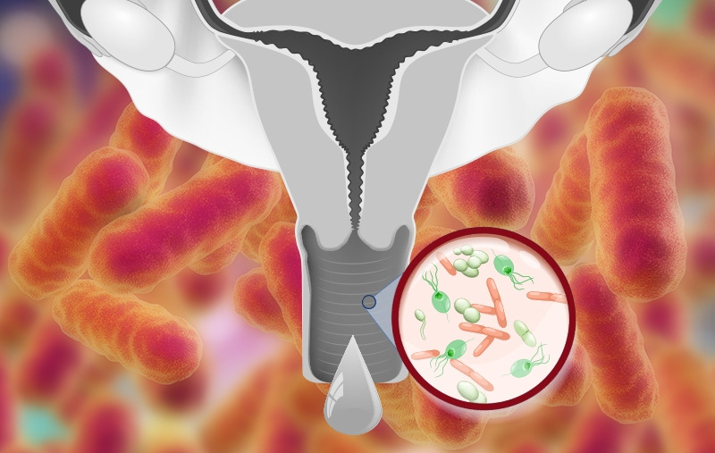10.▶세균성 질염.jpg