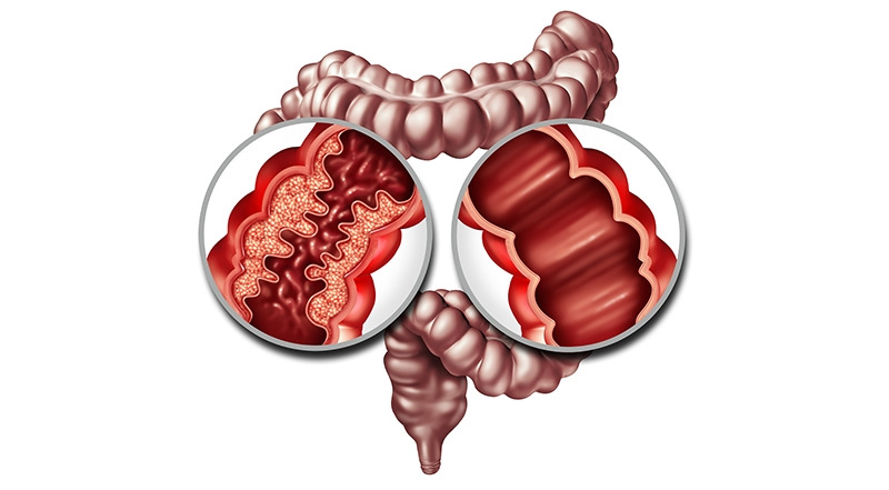 2.▶만성 염증성 장질환.jpg