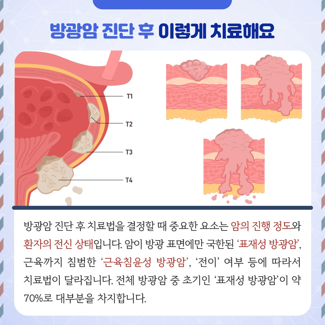 방광암_04.jpg