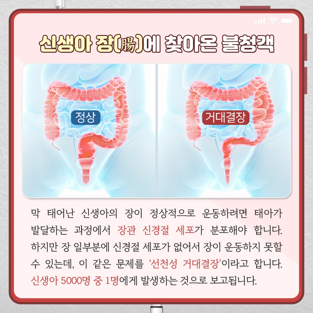 선천성거대결장_02.jpg