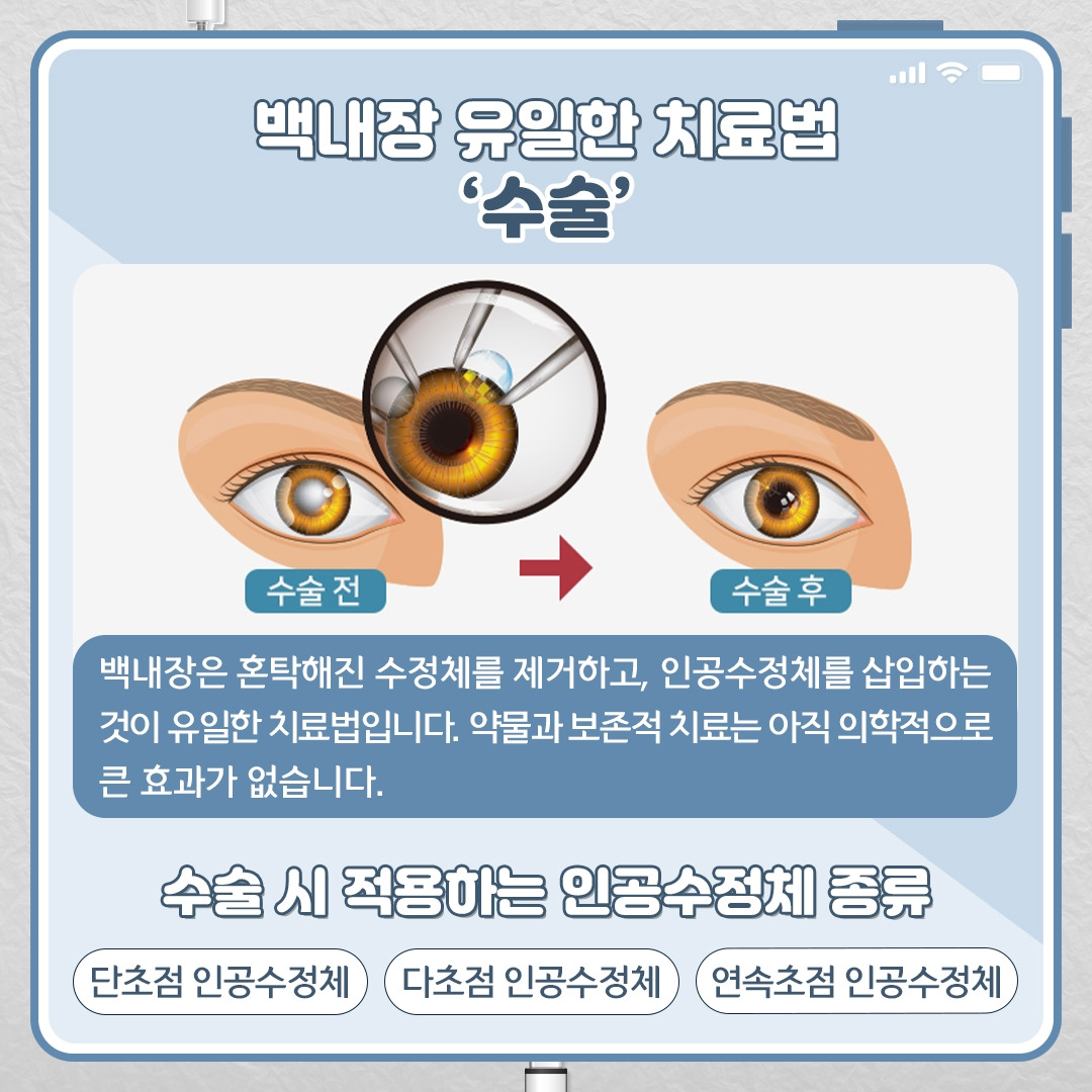 백내장_04 .jpg